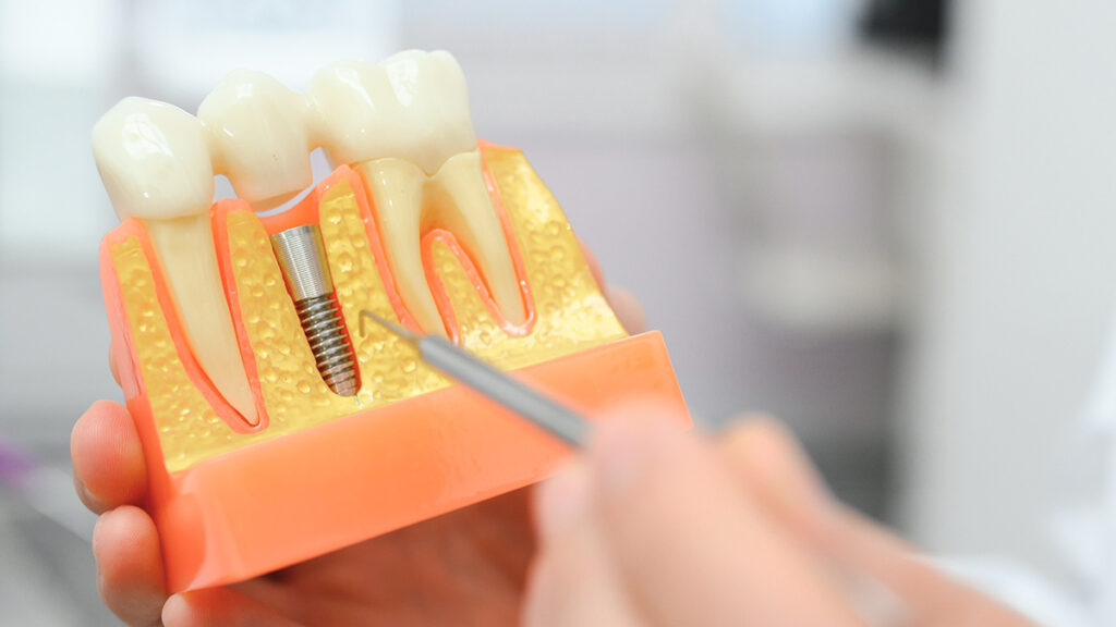 The Benefits of Dental Implants_ Restoring Function