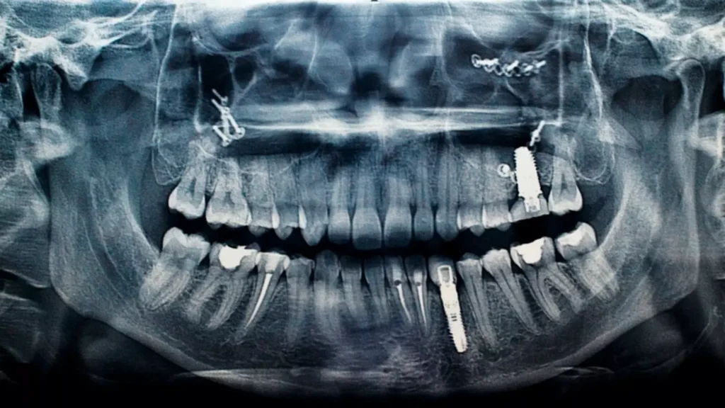 Dental implants x-ray