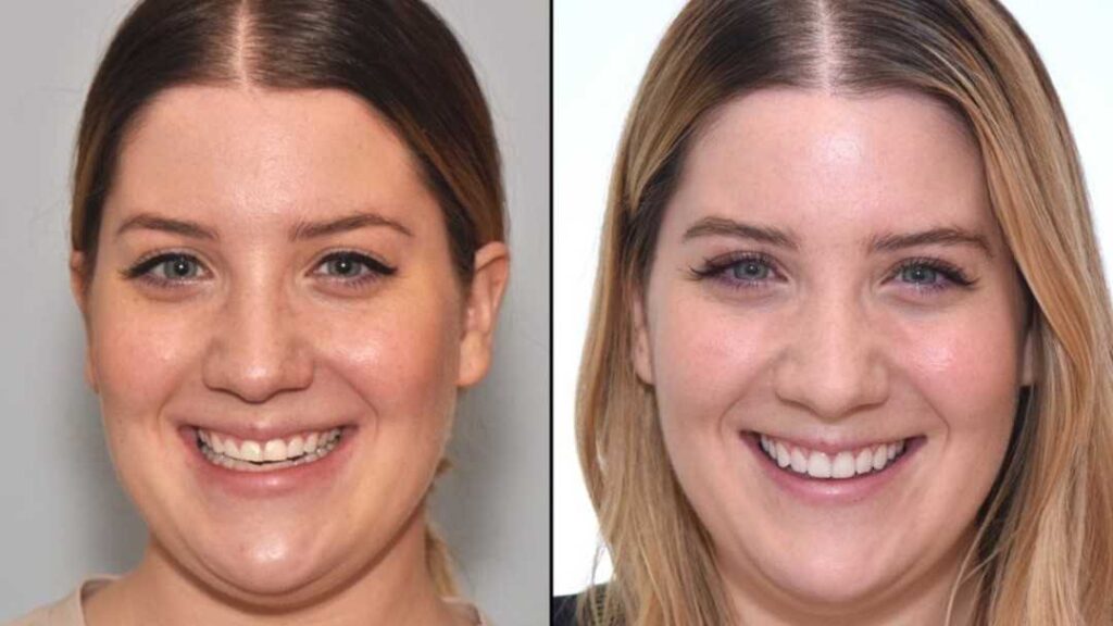 Dental veneers in turkey