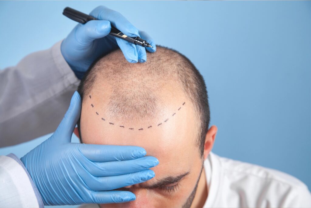 hair transplant cost in turkey