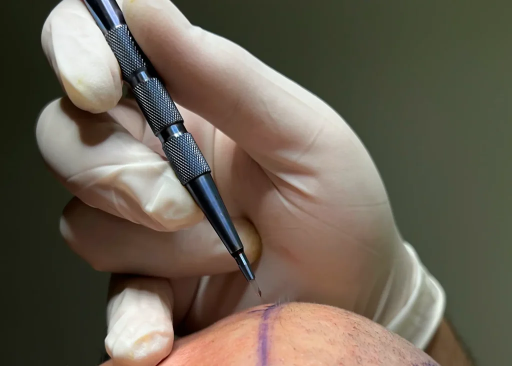 Sapphire FUE Hair Transplant