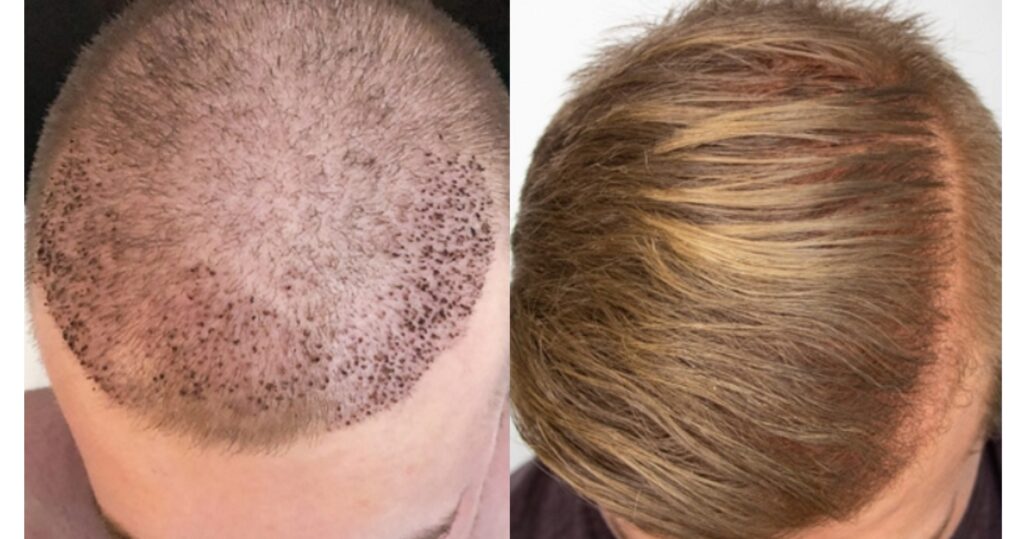 hair transplant before and after