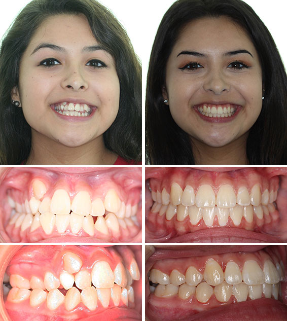 Veneers in Turkey Prices