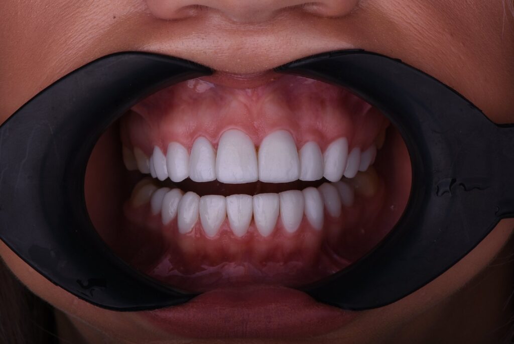 All on 4 Dental Implants Price