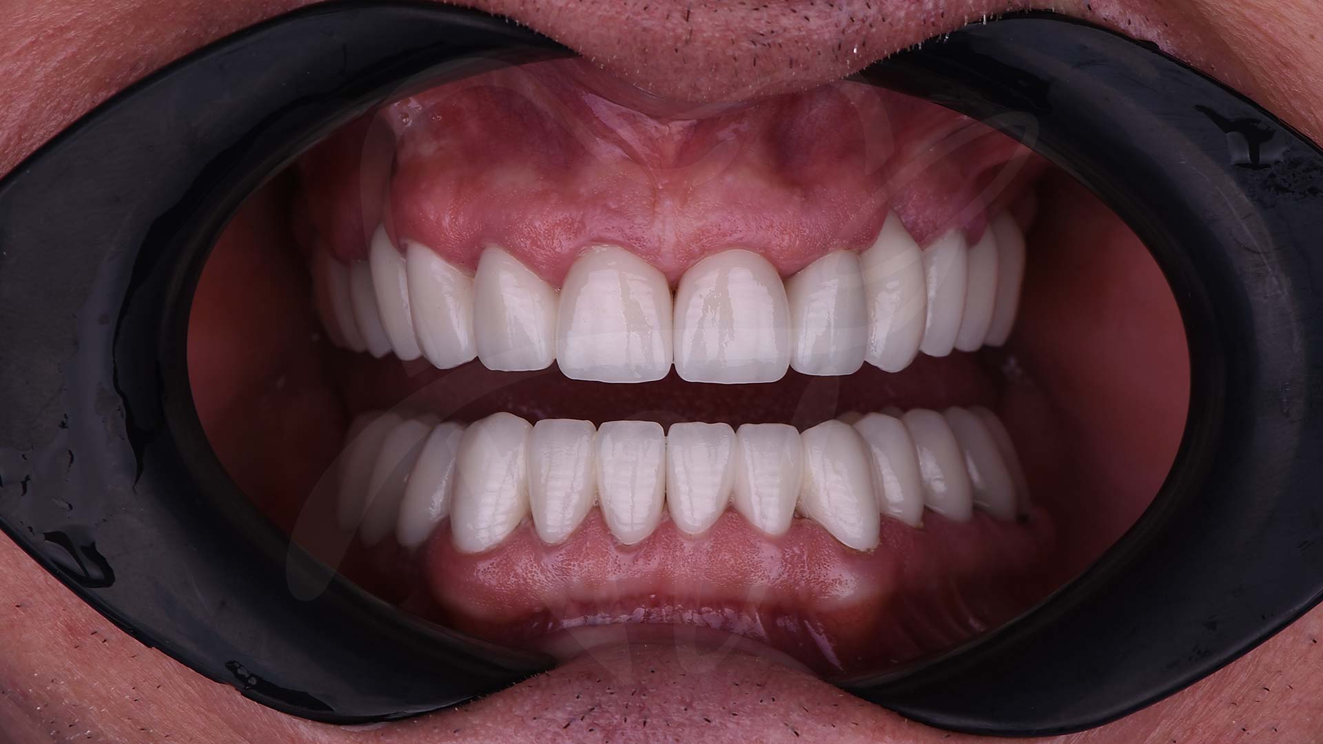 Hollywood Smile in Turkey 2025: Price, Quality & Why It’s a Top Choice