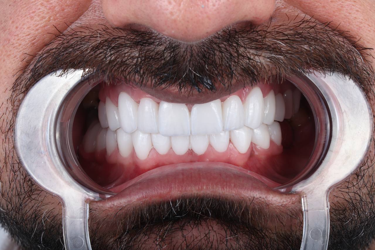 All‑on‑X Prosthetics Compared: Zirconia vs PFM vs Acrylic – What’s Best?