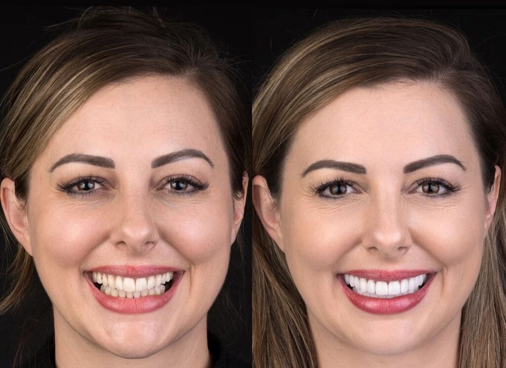 before and after Hollywood smile in turkey
