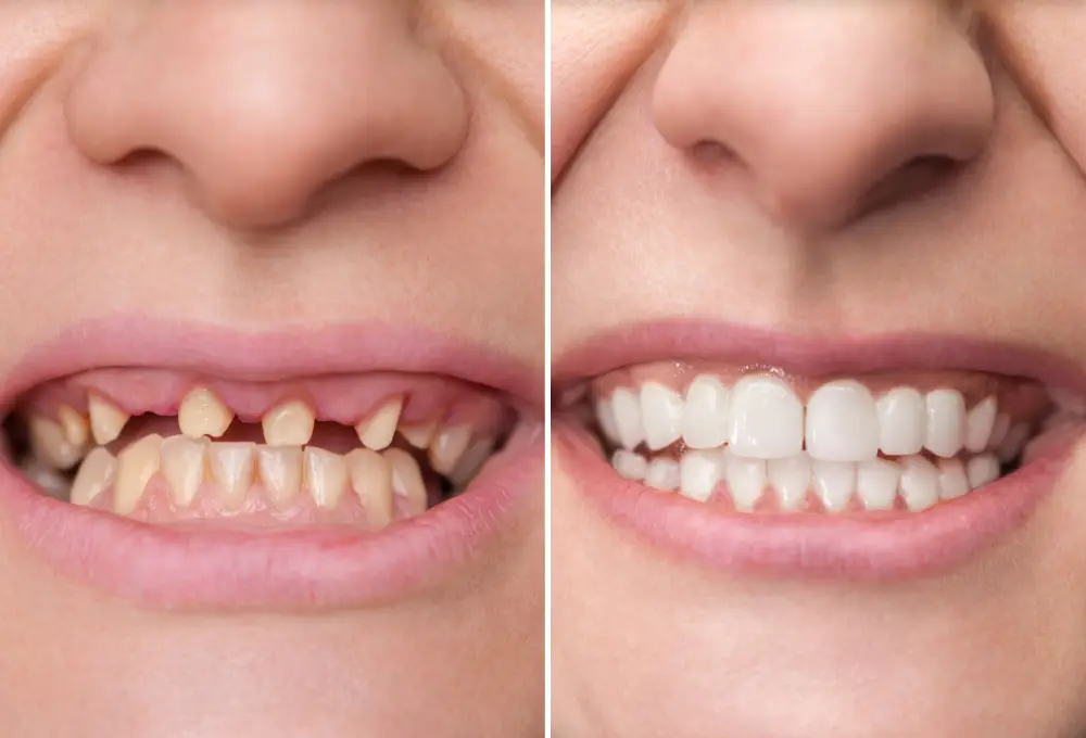 Top Types of Dental Implants in Turkey (2026) – Updated Prices in EUR & USD