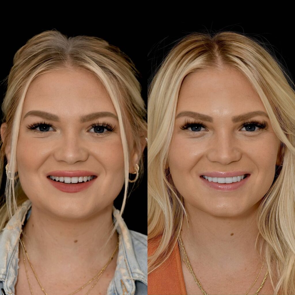 Hollywood smile cost in turkey 2026
