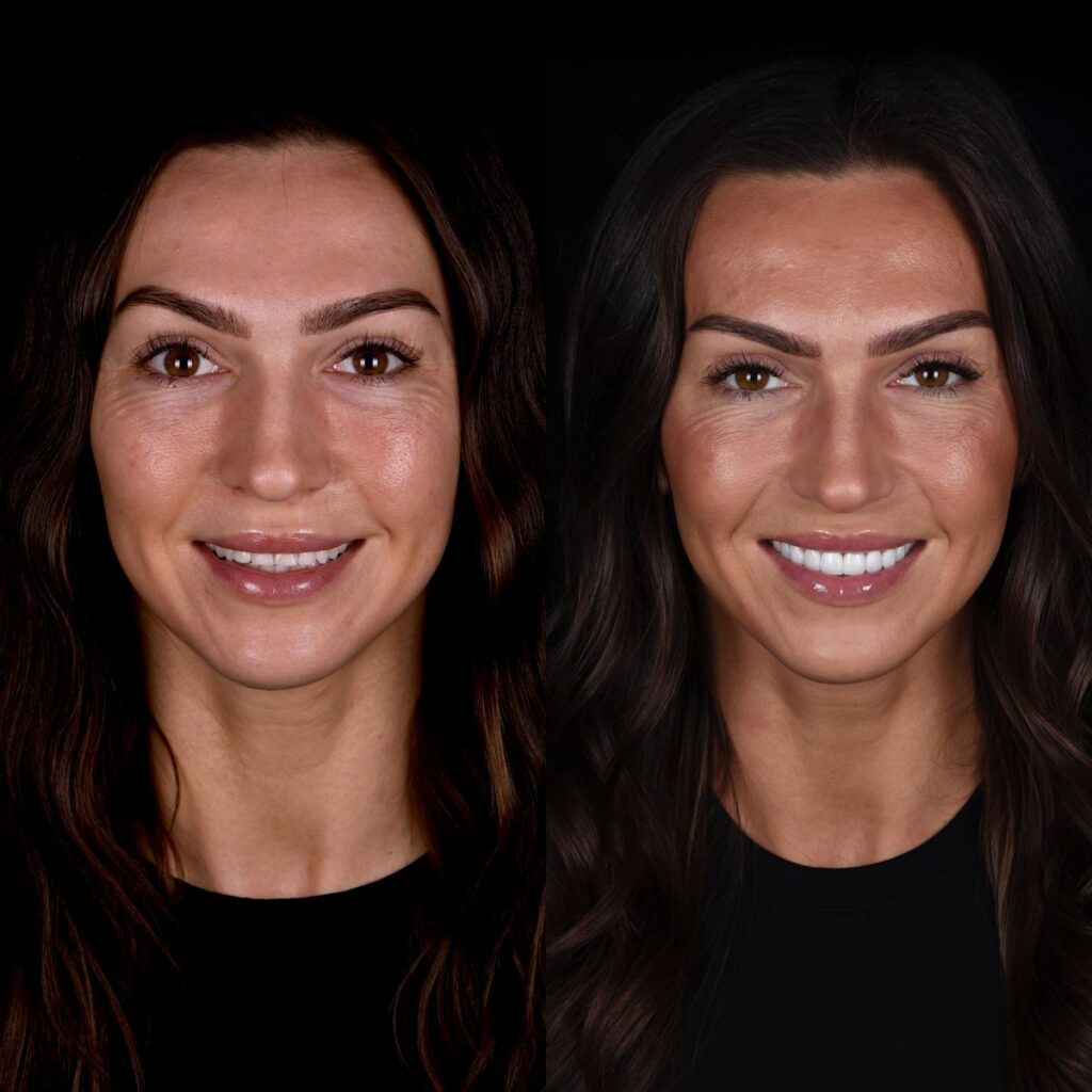 Hollywood smile reviews in turkey