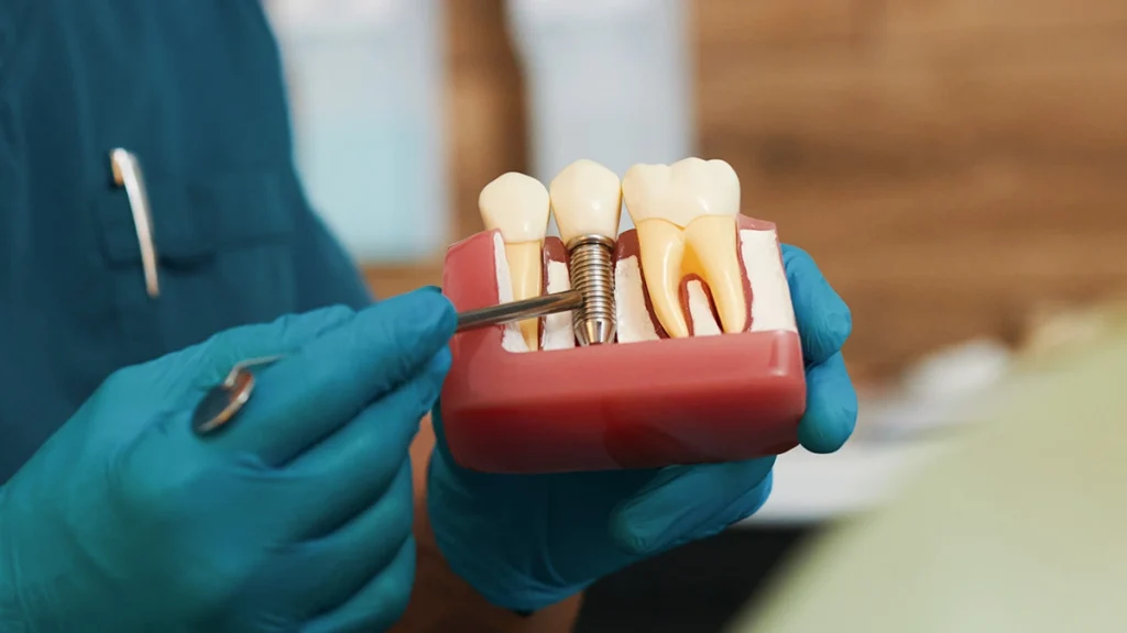 Dental Implants Guide 2026