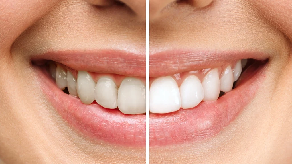 Teeth Whitening 2026