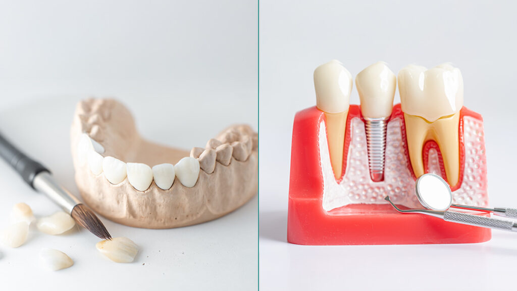 veneers and dental crowns