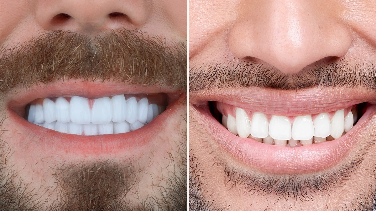 Hollywood Smile vs Smile Makeover: в чём реальная разница?