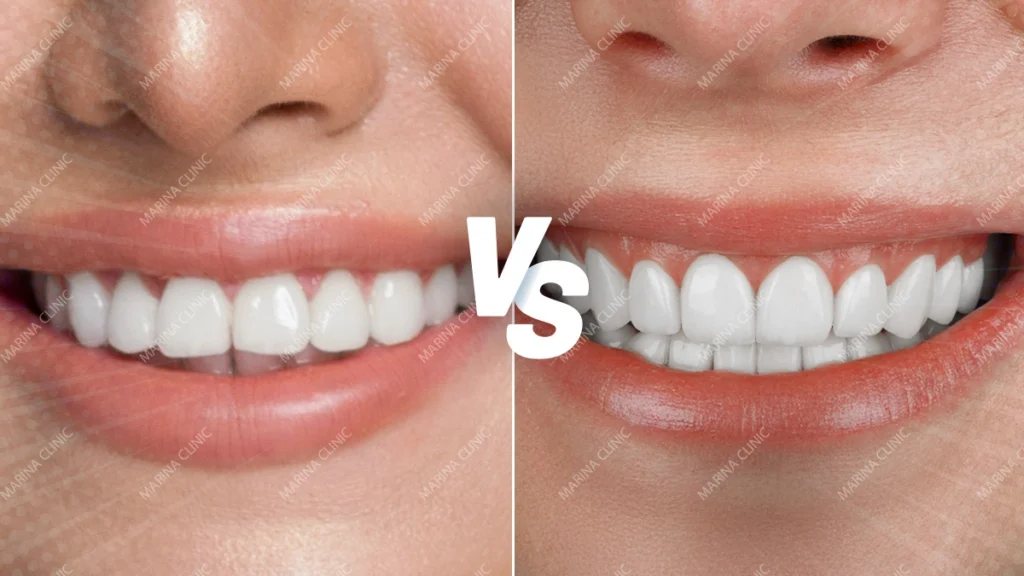 Veneers Price in Turkey