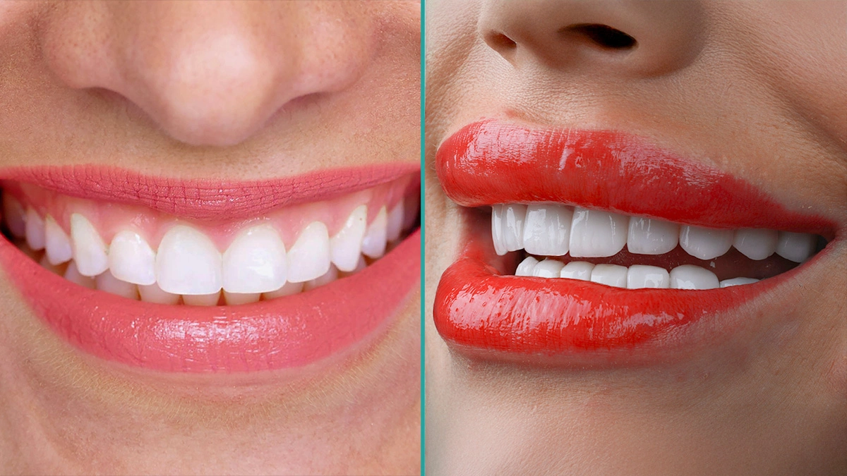 Виниры vs отбеливание: какое лечение действительно меняет вашу улыбку?