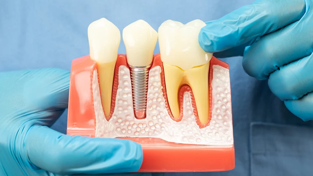 What Are Dental Implants_ How They Work and When They Are Needed