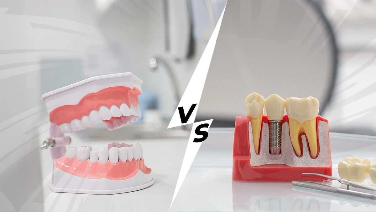 Dental Implants vs Dentures: Stability, Comfort, and Longevity Compared