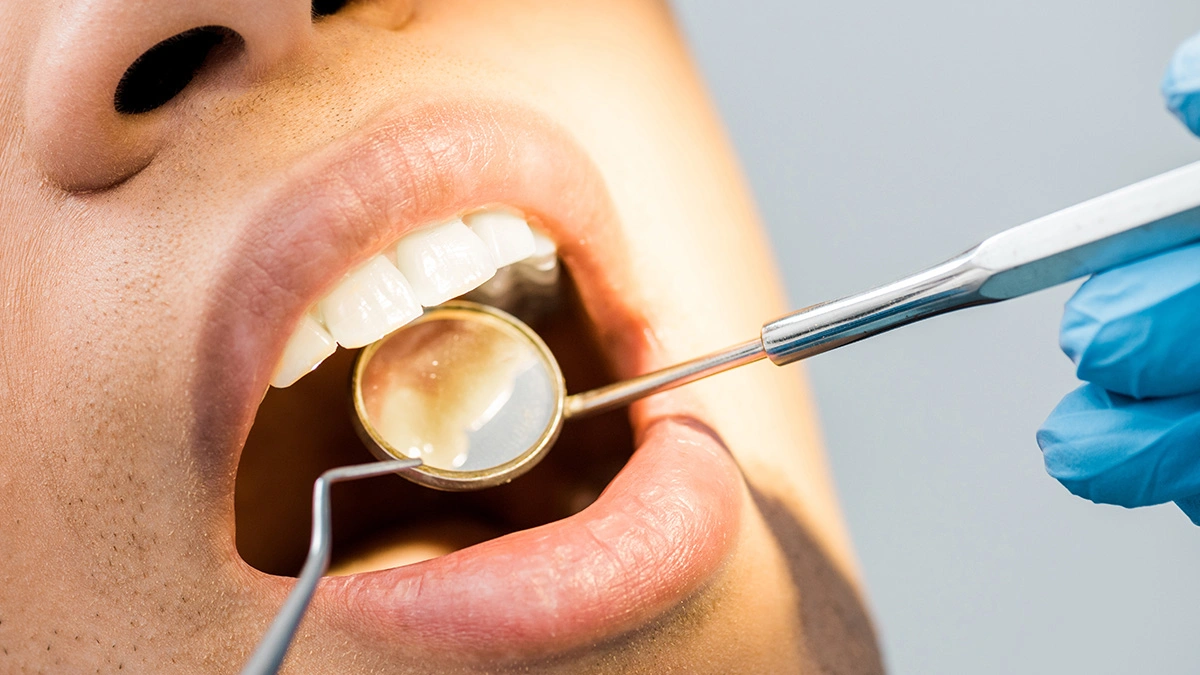 Full Mouth Restoration Explained: When Implants, Crowns, and Veneers Are Combined