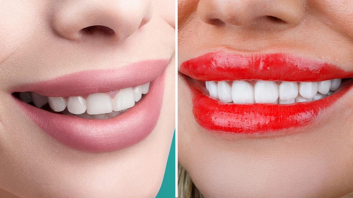Hollywood Smile vs Veneers: Clinical Differences, Results, and Limitations