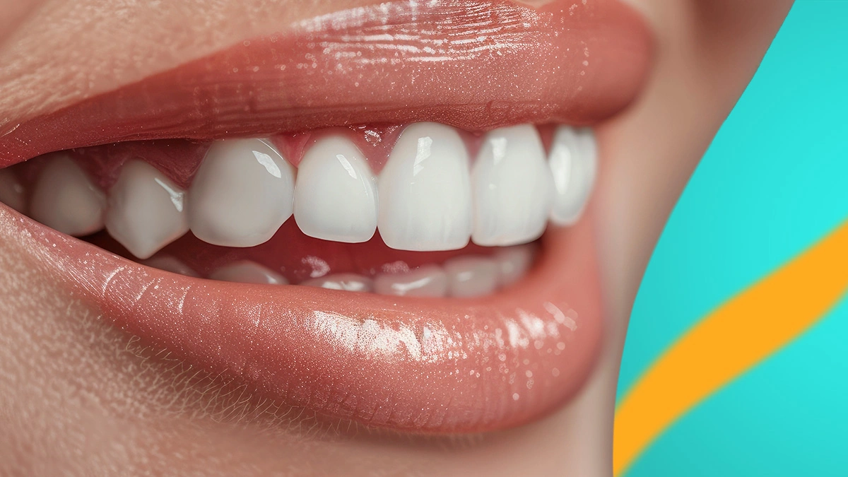 How Long Does a Hollywood Smile Last in Turkey 2026? Veneers, Crowns & Implants Explained