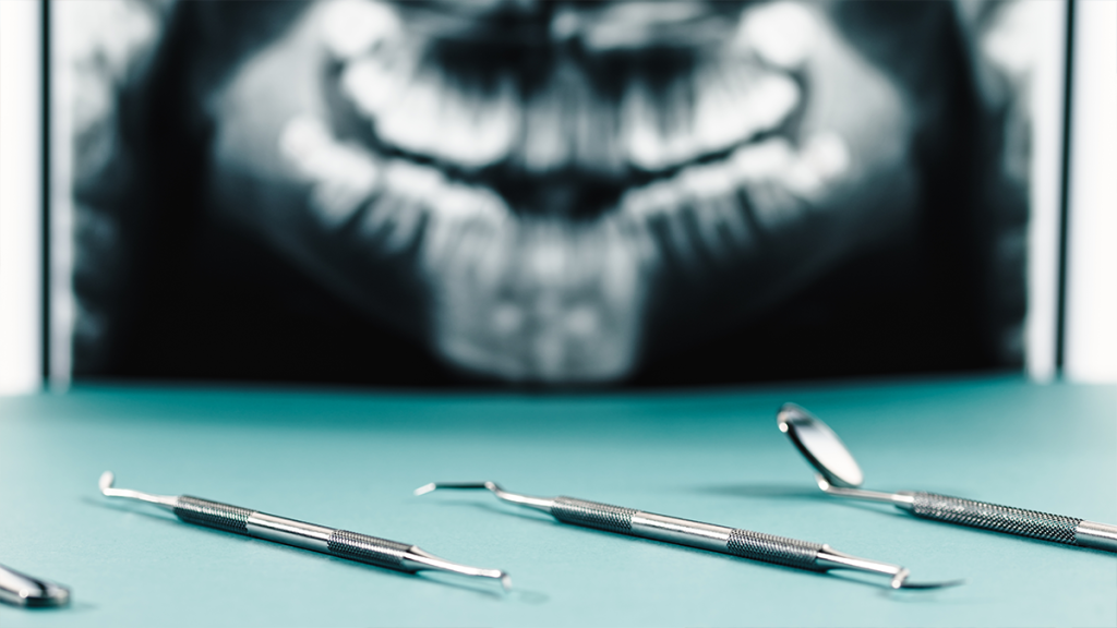 Full Mouth Dental Implants in Istanbul: Cost and Treatment Process