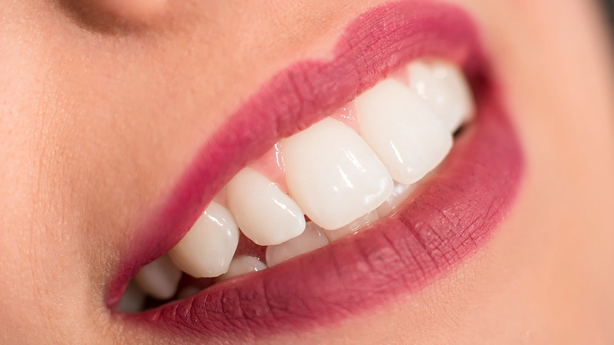 Hollywood Smile Cost in Turkey 2026: Is It Worth It Long-Term?