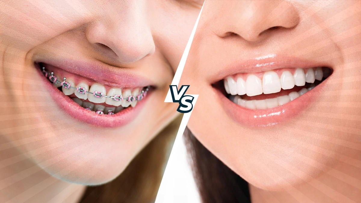 Braces vs Veneers in Turkey: 2026 Cost & Best Option