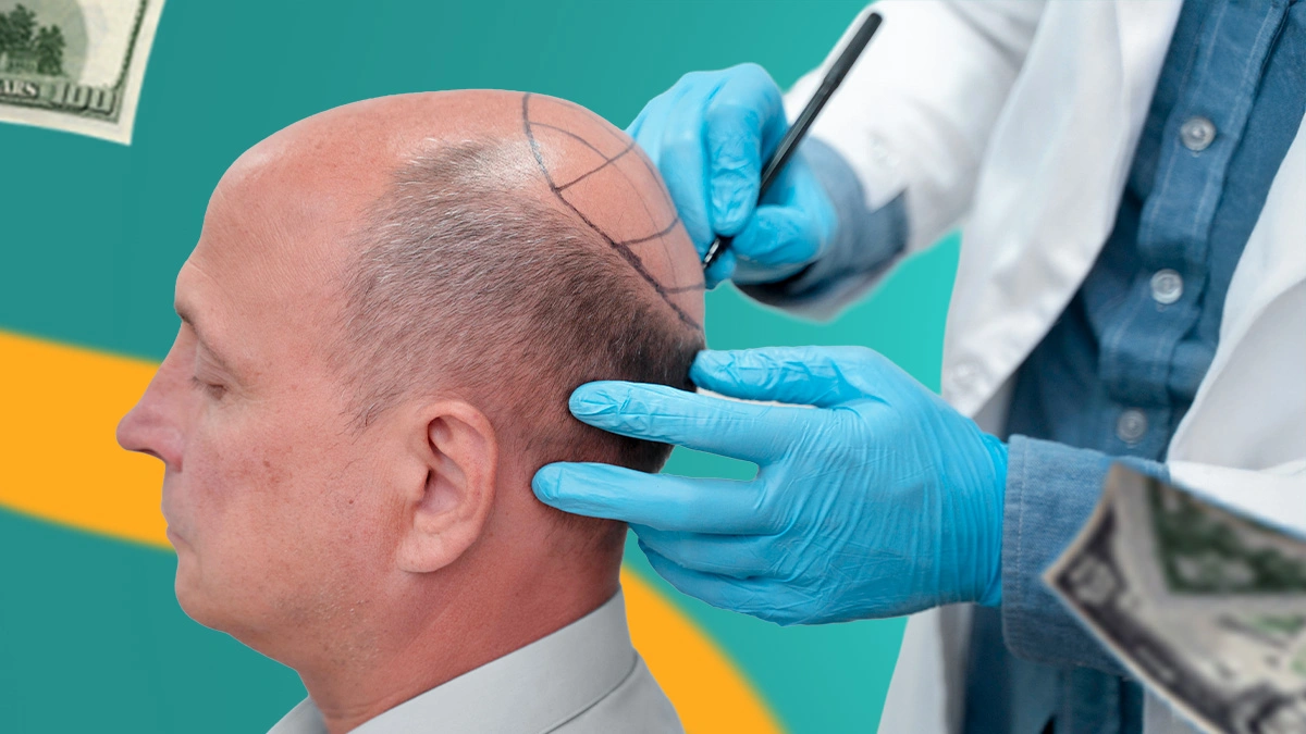 Hair Transplant Turkey vs Europe 2026: Medical Standards, Cost & Techniques Compared