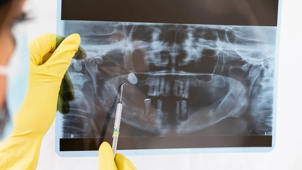 Dentist reviewing jawbone X-ray before dental implant treatment