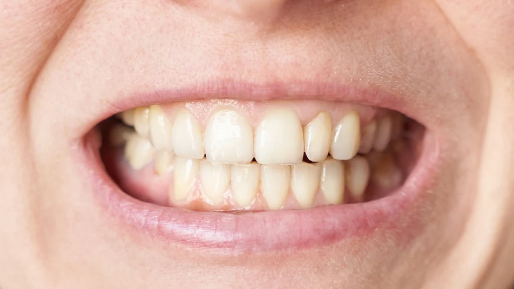 Bruxism and dental implant risk from teeth grinding