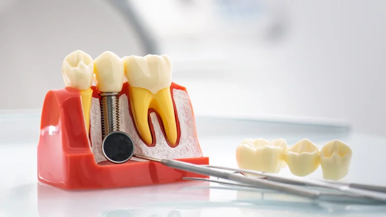 Can You Get Dental Implants with Gum Disease? What to Know Before Treatment