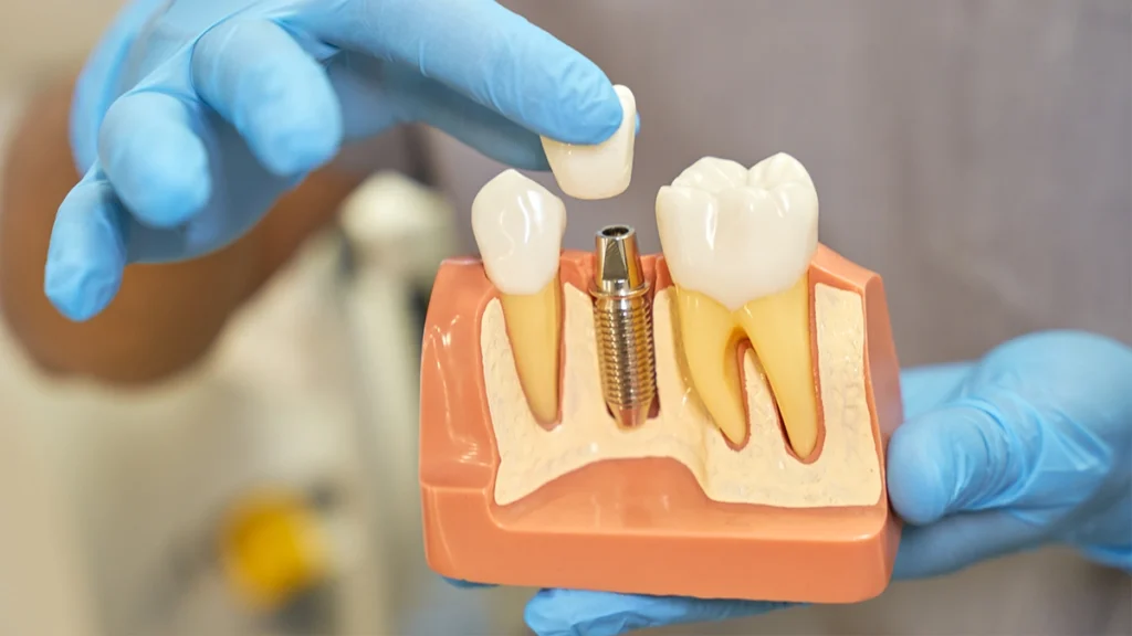 Dental implant model showing crown placement for patients with medical conditions