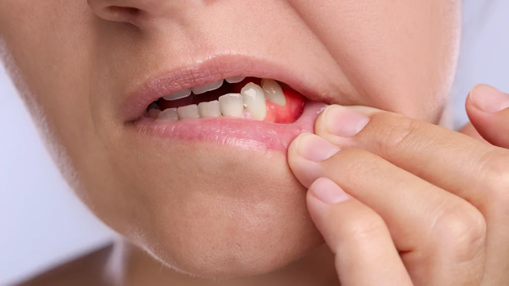 Gum disease symptoms before dental implant treatment