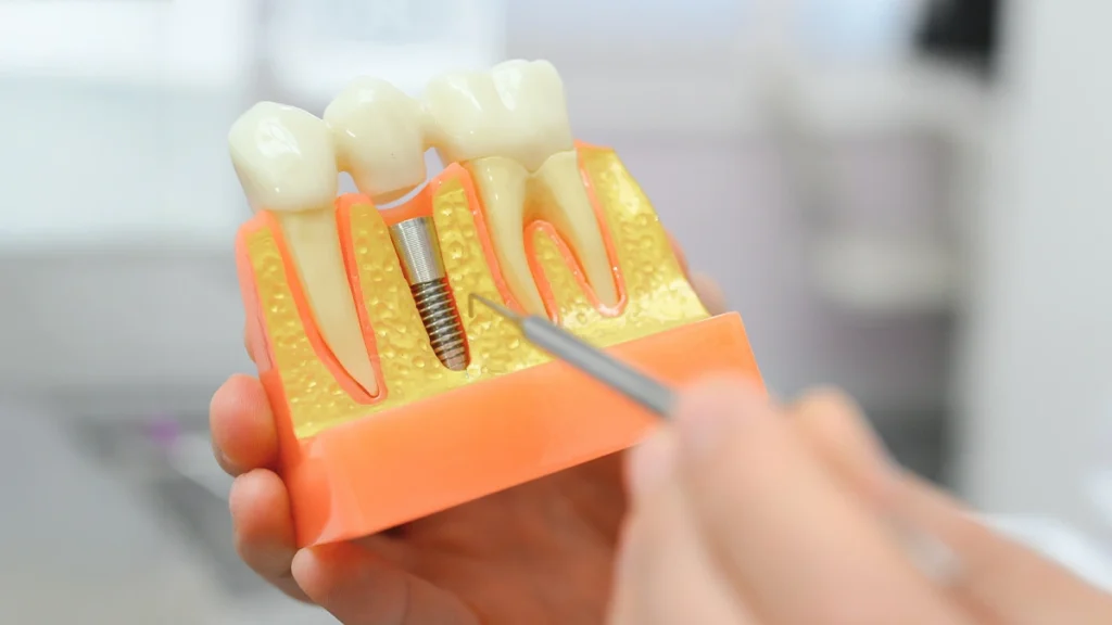Gum disease and dental implants model showing bone support