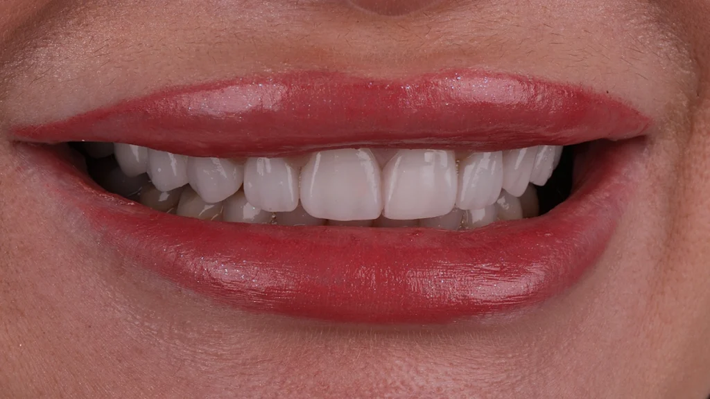 Close-up smile showing white front teeth for Lumineers candidate assessment.