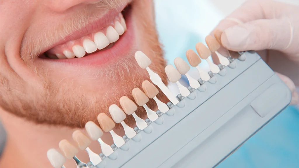 How to Choose the Best Veneer Color for Your Skin Tone_ Smile Design Guide in Turkey 2026