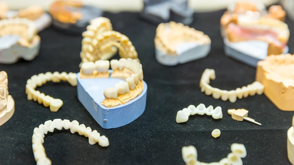 Dental veneer models showing different veneer materials used to customize tooth color, translucency, and smile design.