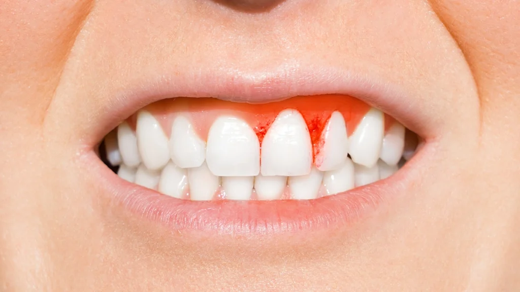 Bleeding gums showing the main risk of dental implants while taking blood thinners