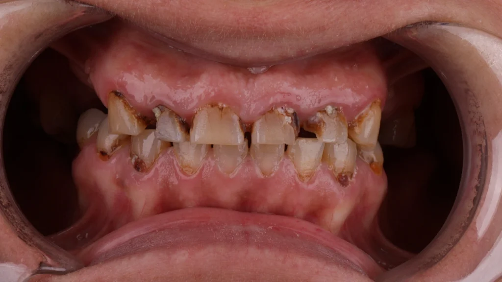 Severe tooth wear and enamel damage caused by long-term bruxism