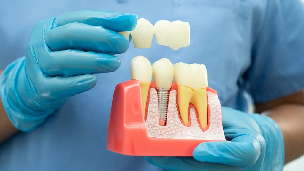 Dentist holding a dental crown beside a tooth and implant model