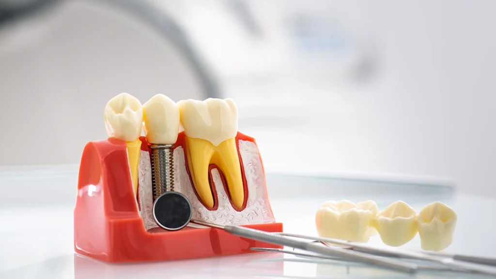 Dental crown model used to plan restorative treatment for patients with bruxism