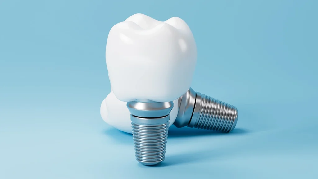 Dental implants and crowns showing how dental implants may help TMJ-related bite problems
