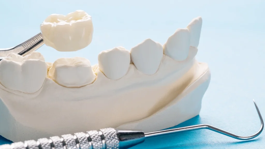 Dental crown placement on a prepared tooth for a patient with bruxism