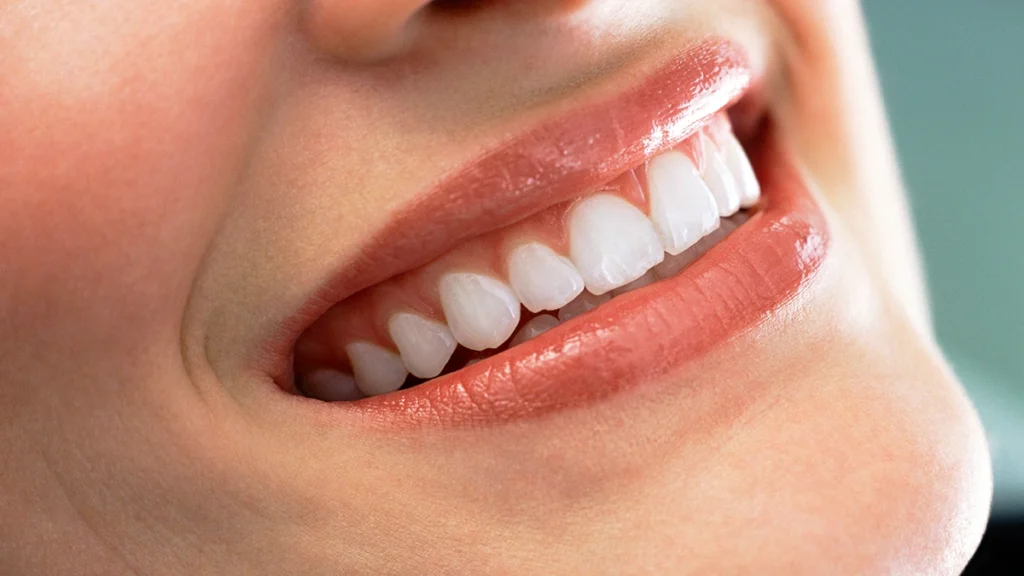 Healthy smile after dental implant planning for patients with bruxism