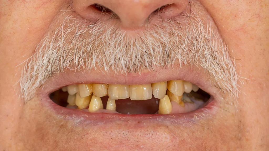 Missing teeth affecting bite balance and contributing to TMJ symptoms