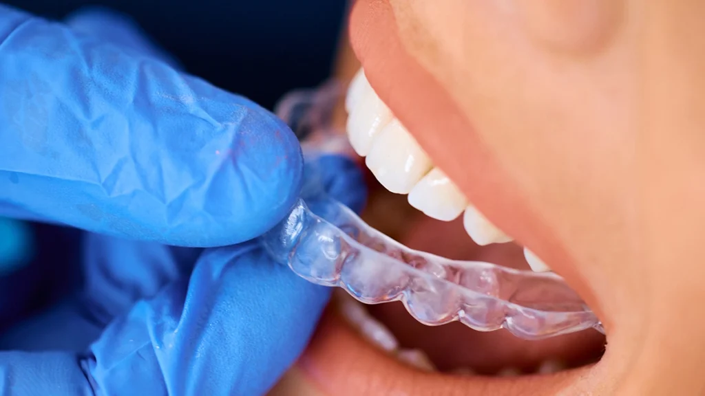Custom night guard protecting teeth from bruxism pressure
