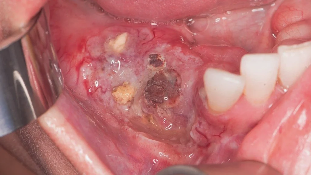 Oral tissue changes affecting dental implant planning after oral cancer