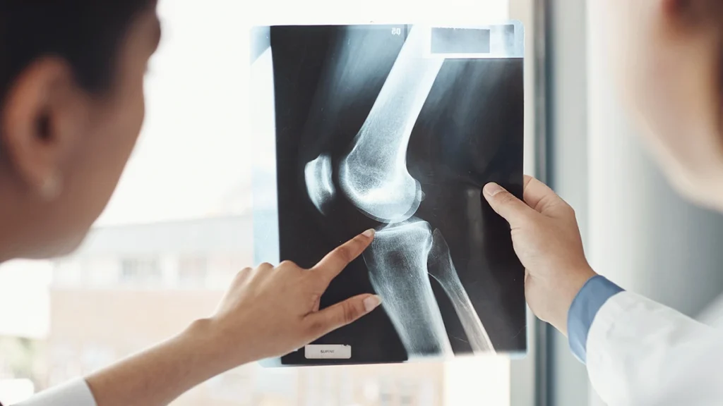Osteoporosis and dental implants with jawbone assessment before implant treatment