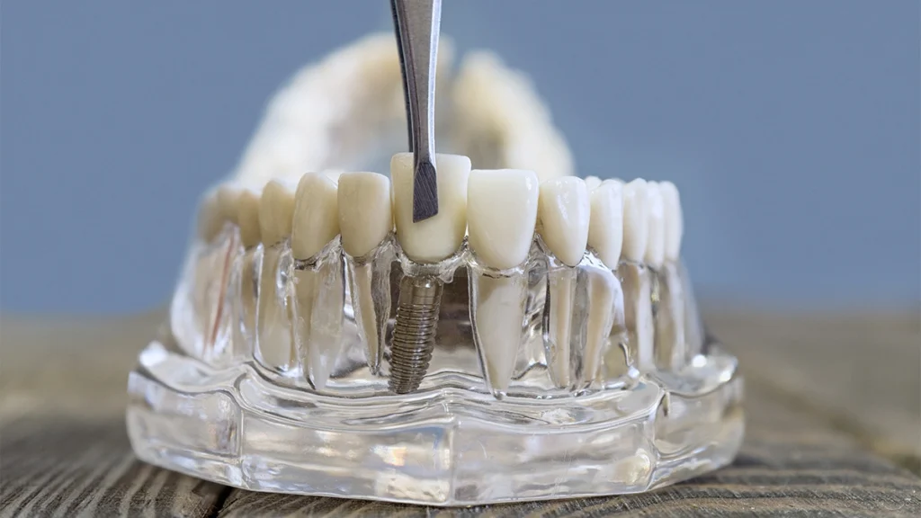 Dental crown placement on a tooth model for a patient with bruxism